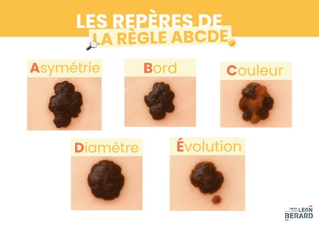 Méthode ABCDE pour repérer un mélanome : - Asymétrie - Bord - Couleur - Diamètre - Evolution