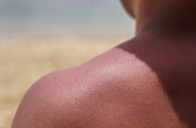 image d'un homme de dos avec un coup de soleil sur l'épaule